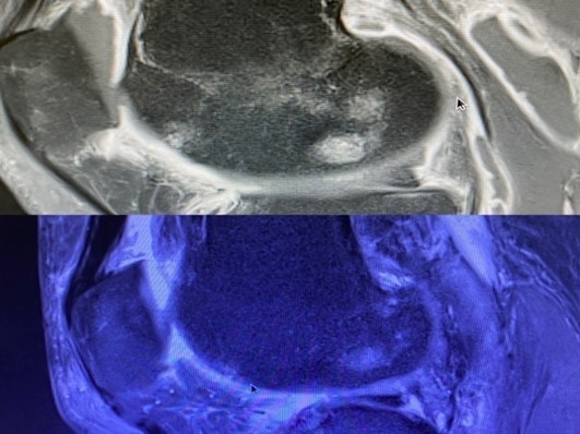 ОА 2-3 ст, контузионный отек с формированием асептического некроза медиального мыщелка бедренной кости, синовит правого КС