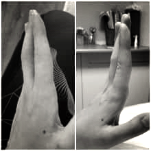 Переломовывих, контрактура средней и дистальной фаланги 3 пальца левой кисти 